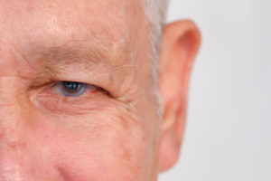 Close up of an older man's eye with signs of glaucoma.