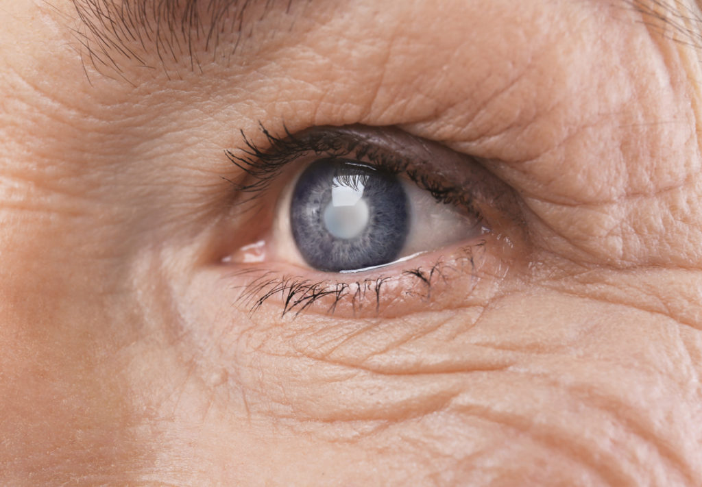 Close up of an older woman's eye with signs of cataracts.
